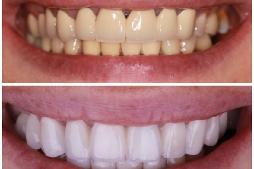 Blanchiment des dents avant et après - 851245