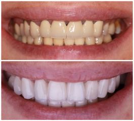 Blanchiment des dents - Dr Ramzi Redissi
