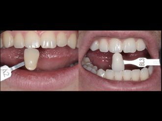 Blanchiment des dents - 854931