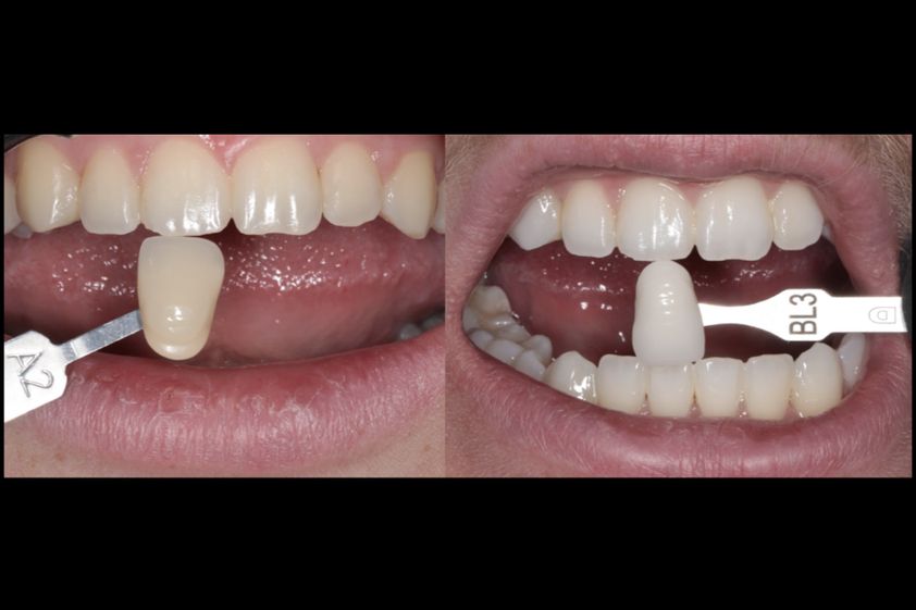 Blanchiment des dents avant et après - 854931