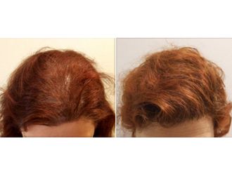 Traitement capillaire - 543291
