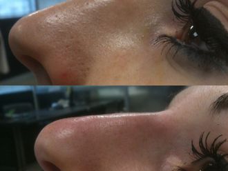 Rhinoplastie médicale - 647105