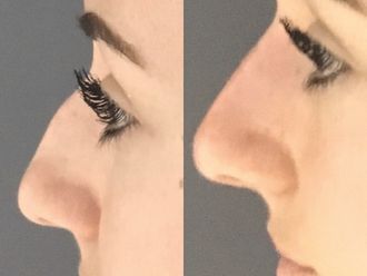 Rhinoplastie - 647635
