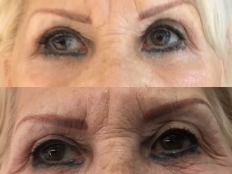 Botox - 647637