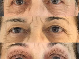 Blépharoplastie - 647640