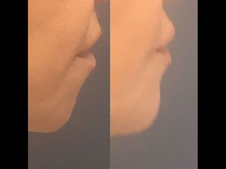 Acide hyaluronique - Dr Jérôme Quezel-Guerraz