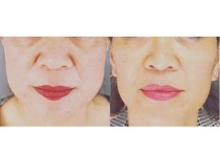 Augmentation des lèvres - Dr Catherine Eychenne