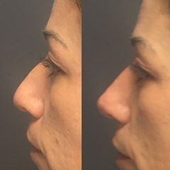 Rhinoplastie médicale - Dr Jérôme Quezel-Guerraz