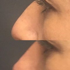Rhinoplastie médicale - Dr Jérôme Quezel-Guerraz