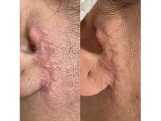 Otoplastie avant et après - 814692