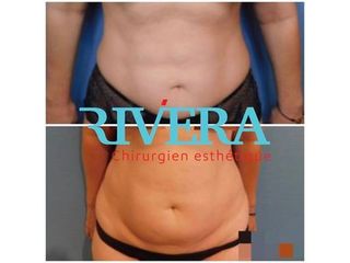Abdominoplastie - Dr Juan Carlos Rivera