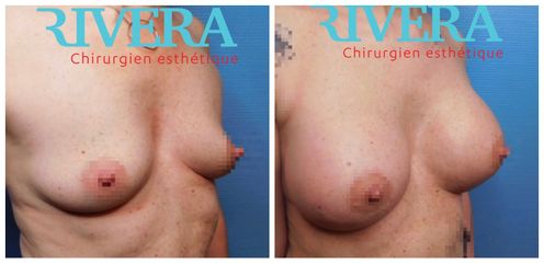 Augmentation mammaire - Dr Juan Carlos Rivera