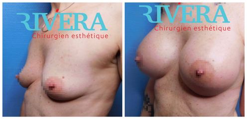 Augmentation mammaire - Dr Juan Carlos Rivera