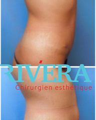Abdominoplastie - Dr Juan Carlos Rivera