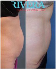 Abdominoplastie - Dr Juan Carlos Rivera