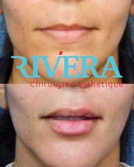 Augmentation des lèvres - Dr Juan Carlos Rivera