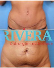 Abdominoplastie - Dr Juan Carlos Rivera