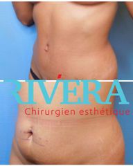 Abdominoplastie - Dr Juan Carlos Rivera