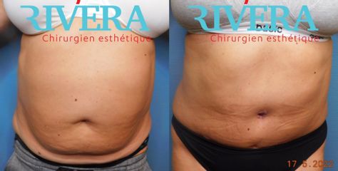 Abdominoplastie - Dr Juan Carlos Rivera