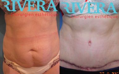 Abdominoplastie - Dr Juan Carlos Rivera
