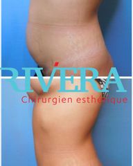 Abdominoplastie - Dr Juan Carlos Rivera