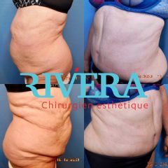 Abdominoplastie - Dr Juan Carlos Rivera