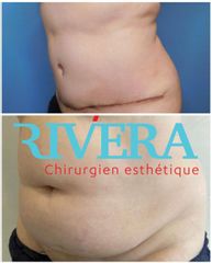 Abdominoplastie - Dr Juan Carlos Rivera