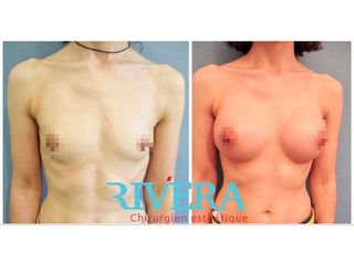 Augmentation mammaire - Dr Juan Carlos Rivera