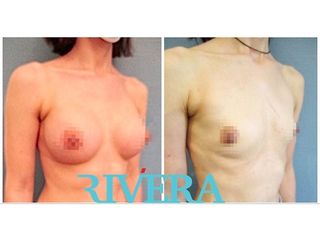 Augmentation mammaire - Dr Juan Carlos Rivera
