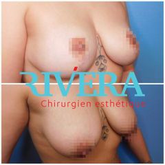 Mastopexie - Dr Juan Carlos Rivera