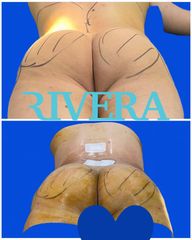 Chirurgie des fesses - Dr Juan Carlos Rivera