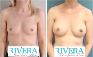 Augmentation mammaire - Dr Juan Carlos Rivera