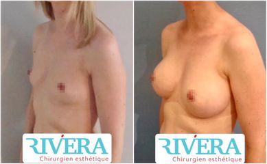 Augmentation mammaire - Dr Juan Carlos Rivera