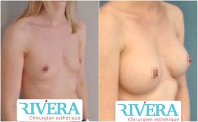 Augmentation mammaire - Dr Juan Carlos Rivera