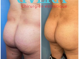 Chirurgie des fesses avant et après - 843804