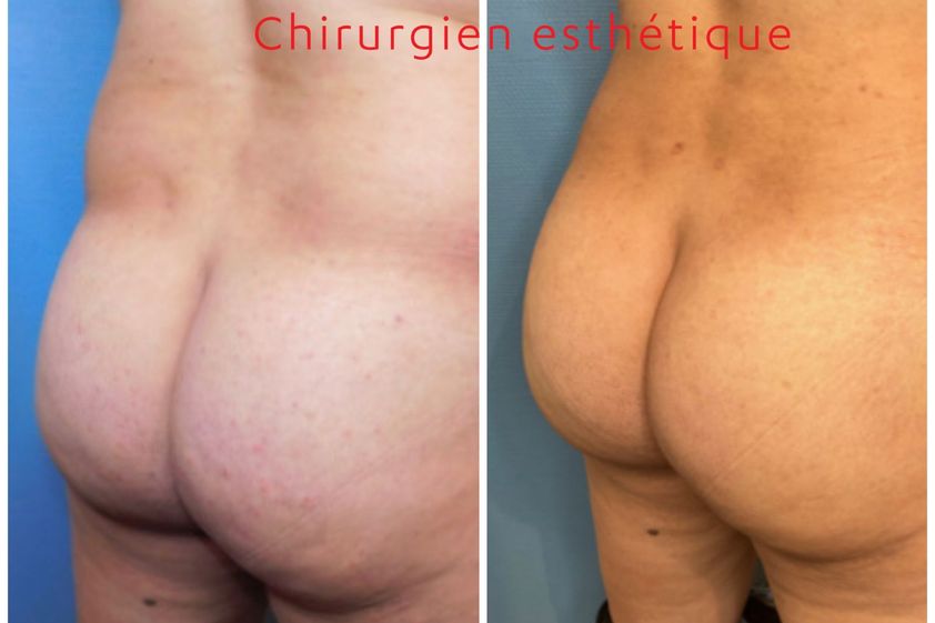 Chirurgie des fesses avant et après - 843804