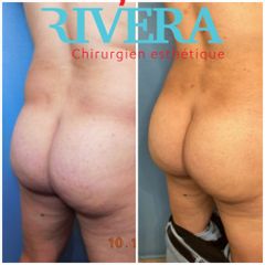 Chirurgie des fesses - Dr Juan Carlos Rivera