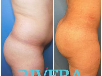 Chirurgie des fesses avant et après - 843805