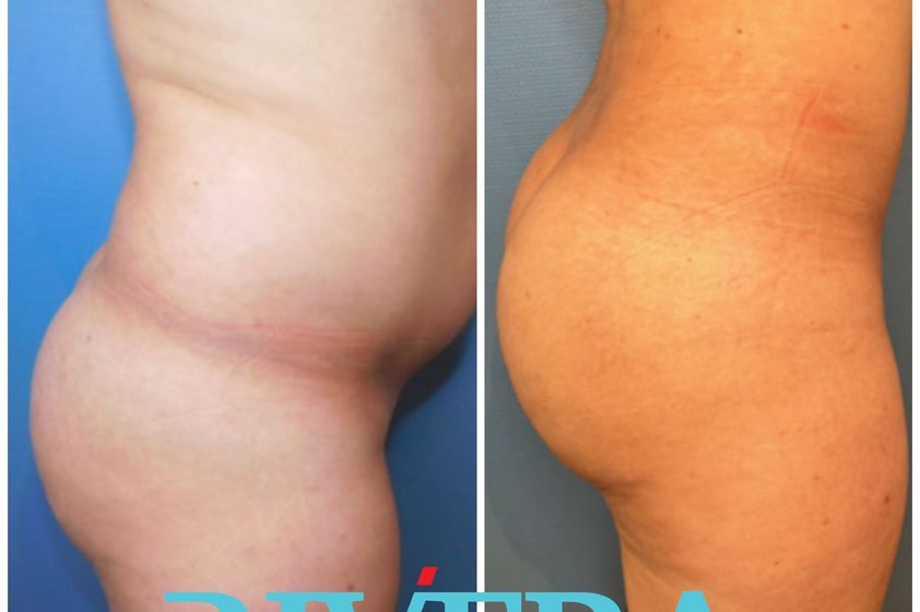 Chirurgie des fesses avant et après - 843805