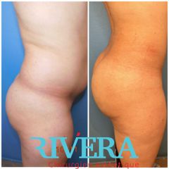 Chirurgie des fesses - Dr Juan Carlos Rivera