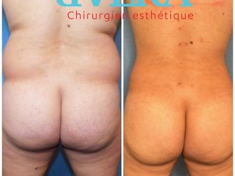 Chirurgie des fesses avant et après - 843806