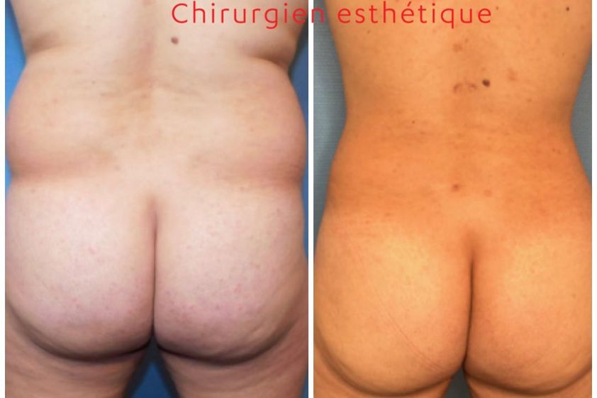 Chirurgie des fesses avant et après - 843806