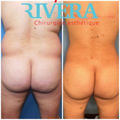 Chirurgie des fesses - Dr Juan Carlos Rivera