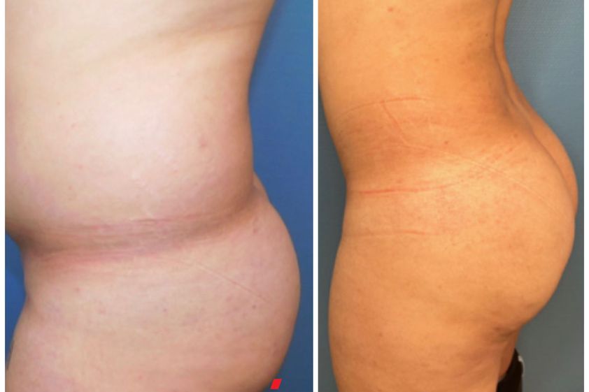 Chirurgie des fesses avant et après - 843807