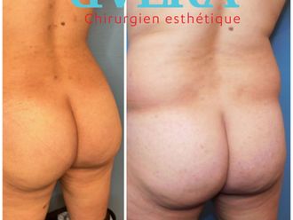 Chirurgie des fesses avant et après - 843808