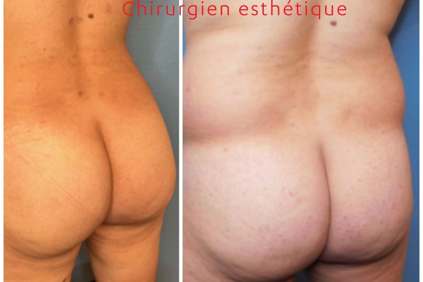Chirurgie des fesses avant et après - 843808