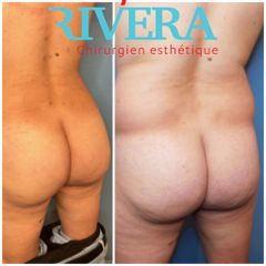Chirurgie des fesses - Dr Juan Carlos Rivera