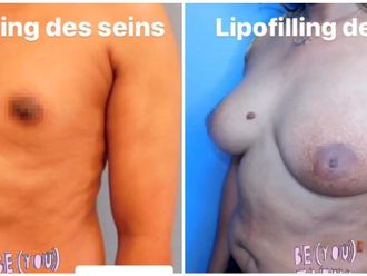 Lipofilling avant et après - 850922