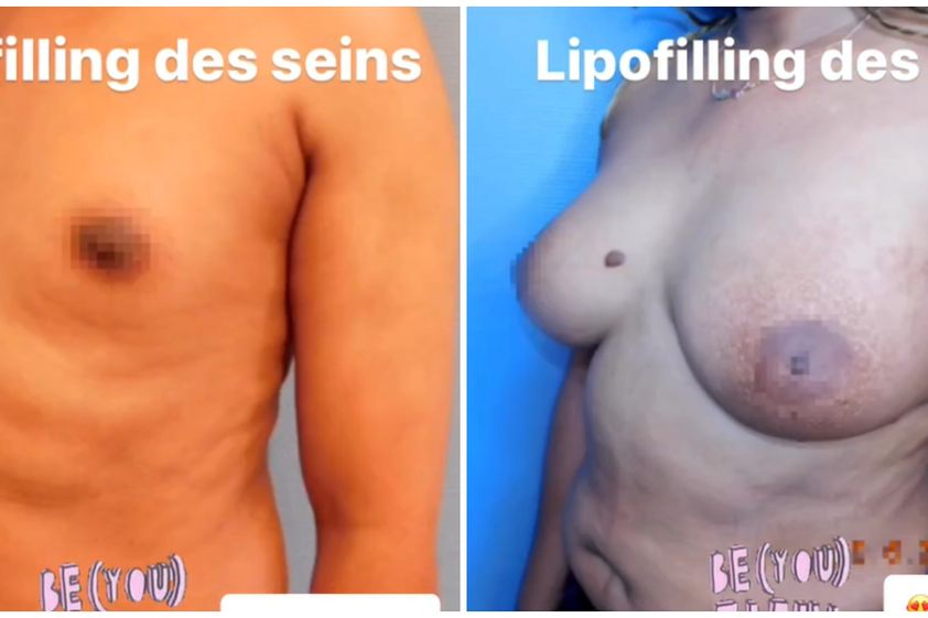 Lipofilling avant et après - 850922