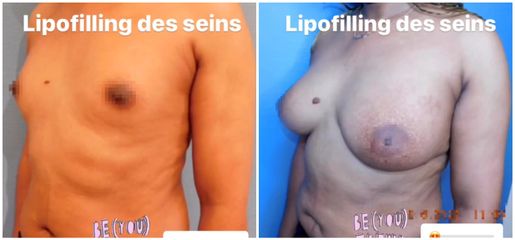 Lipofilling des seins - Dr Juan Carlos Rivera